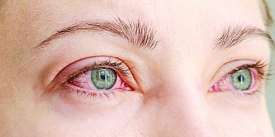 50 Yaş Altı Körlüğün Birinci Nedeni: Diyabetik Retinopati