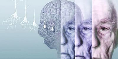 Alzheimer'a umut olacak keşif!