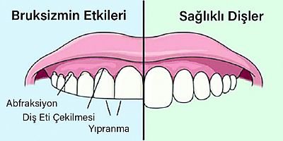 Diş Sıkmak ve diş gıcırdatmak çok tehlikeli